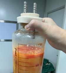 怀化水动力吸脂手术要做多久？